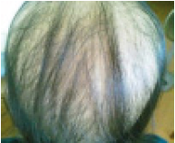 chemotherapy hair loss