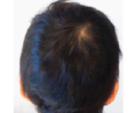 chemotherapy hair loss