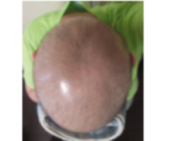 chemotherapy hair loss