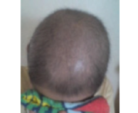 chemotherapy hair loss