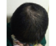 chemotherapy hair loss