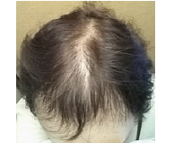 chemotherapy hair loss