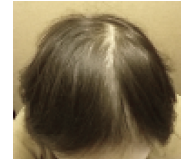 chemotherapy hair loss