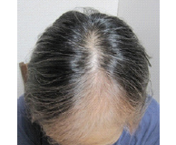 chemotherapy hair loss