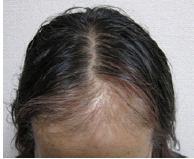 chemotherapy hair loss