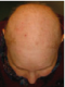 CG428 Chemoterapy Hair loss