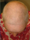 CG428 Chemoterapy Hair loss