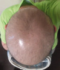 CG428 Chemoterapy Hair loss