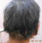 CG428 Chemoterapy Hair loss