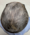 hairloss_treatment