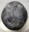 hairloss_treatment