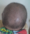 CG428 Chemoterapy Hair loss