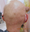 hairloss_treatment