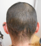 hairloss_treatment