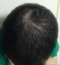 CG428 Chemoterapy Hair loss