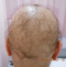 CG428 Chemoterapy Hair loss