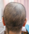 CG428 Chemoterapy Hair loss