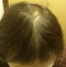 hairloss_treatment