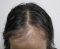 hairloss_treatment