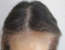 hairloss_treatment