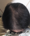 hairloss_treatment