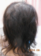 hairloss_treatment