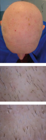 CG428 Chemoterapy Hair loss