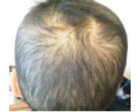 chemotherapy hair loss