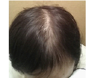 chemotherapy hair loss