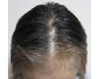 chemotherapy hair loss