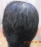 CG428 Chemoterapy Hair loss