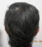 CG428 Chemoterapy Hair loss