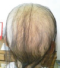 CG428 Chemoterapy Hair loss