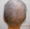 CG428 Chemoterapy Hair loss