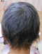 CG428 Chemoterapy Hair loss