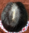 hairloss_treatment