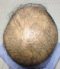 hairloss_treatment