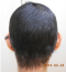 hairloss_treatment