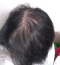 hairloss_treatment