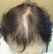 hairloss_treatment