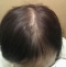 hairloss_treatment