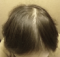 hairloss_treatment