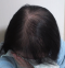 hairloss_treatment