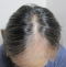 hairloss_treatment