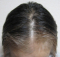 hairloss_treatment