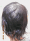 hairloss_treatment